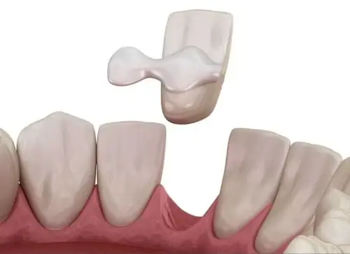 Soins dentaires bridge colle dentition