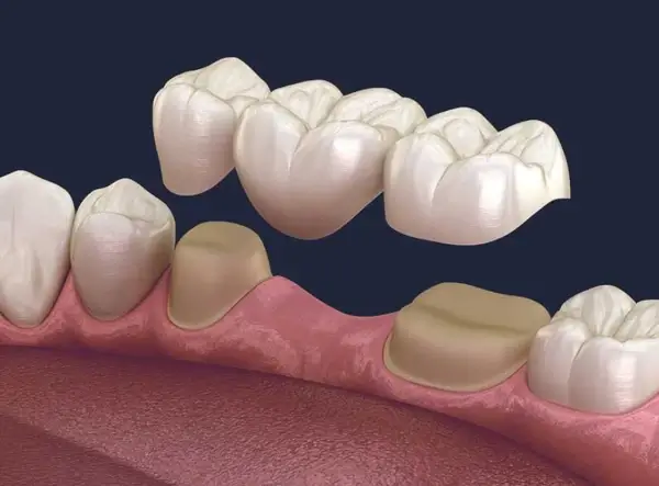 Soins dentaires bridge dentition machoire patient grau du roi