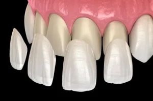 Soins dentaires facette ceramique dentition