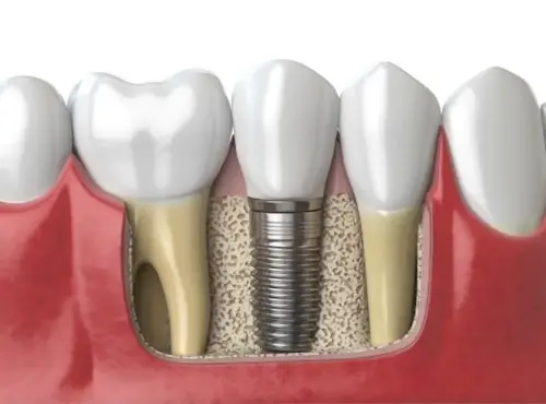 Soins dentaires implant traitement radiculaire cabinet dentaire grau du roi