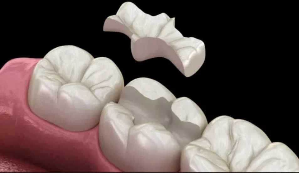Soins dentaires inlay ceramique dentiste crebassa grau du roi