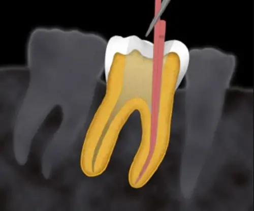 Soins dentaires traitement racine cabinet dentiste grau du roi